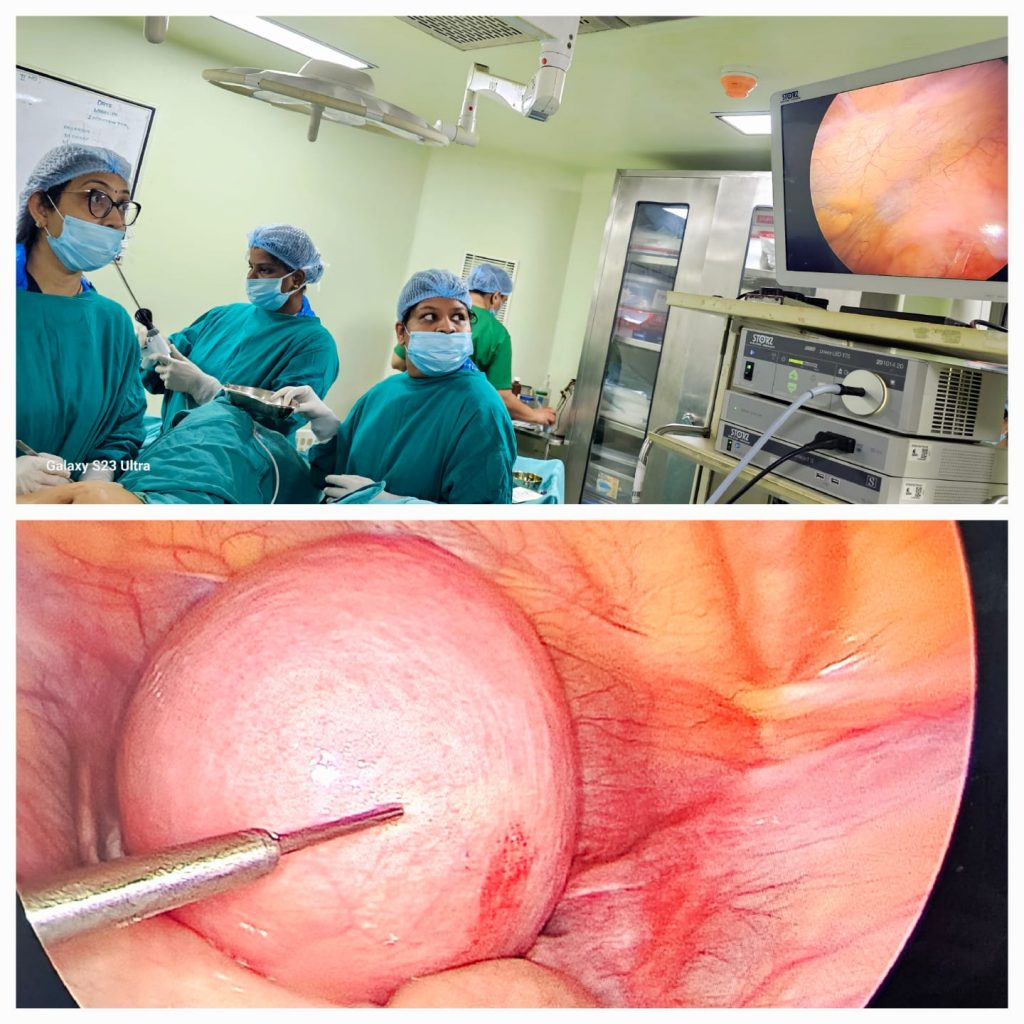 Successful removal of a 10cm Fibroid without any damage to uterus